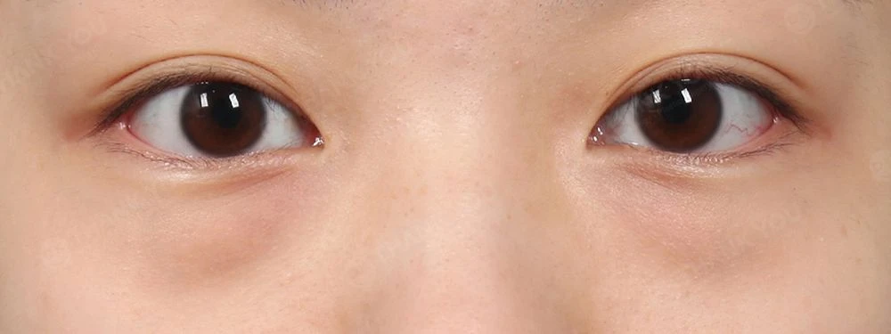 before_image