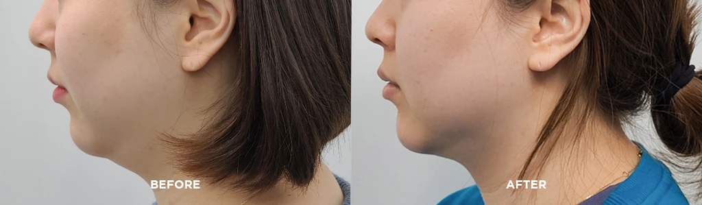 before_after