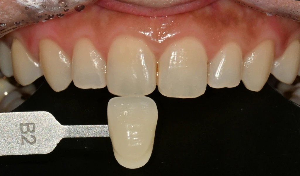 before_image