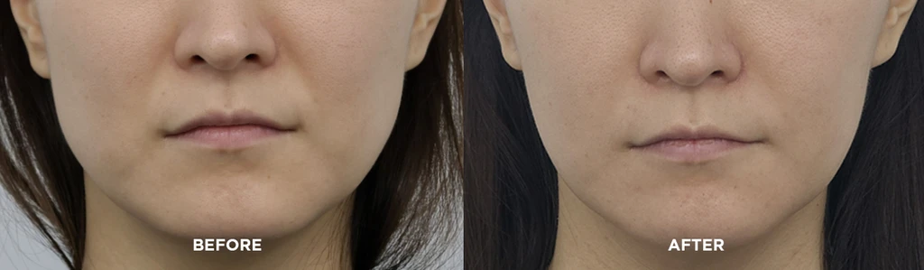 before_after