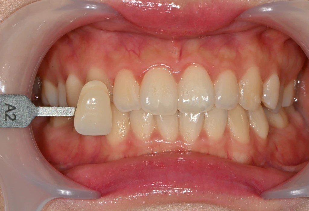 before_image