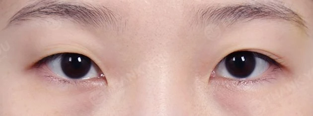 before_image
