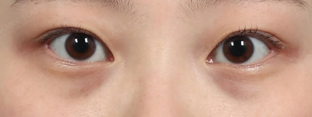 before_image