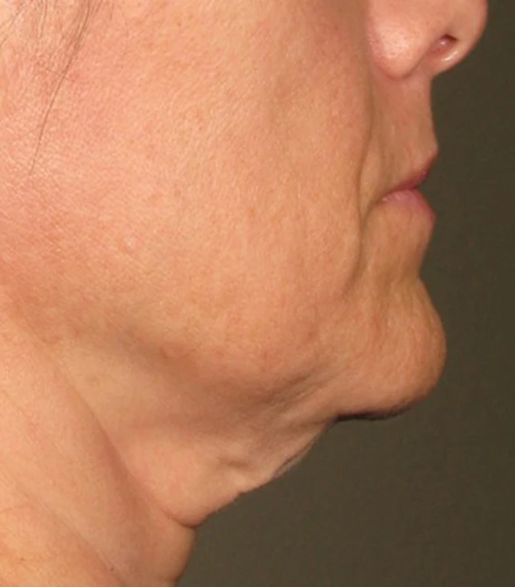 before_image