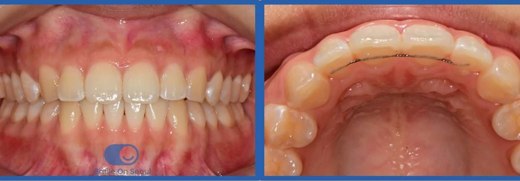 before_image