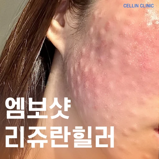 treatment-event-thumbnail