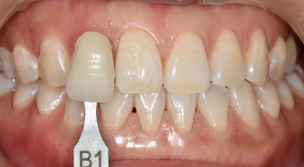 before_image