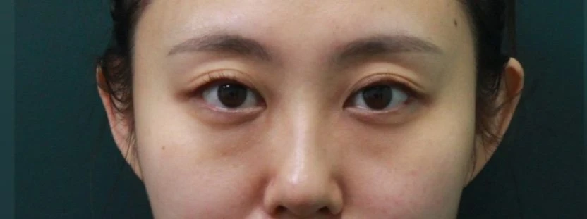 before_image