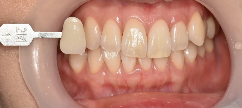 before_image