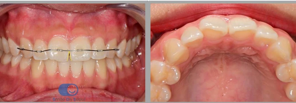 before_image