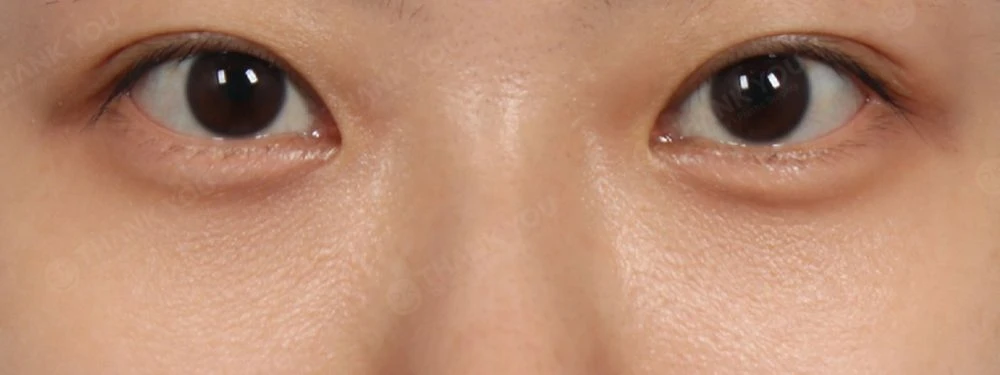 before_image