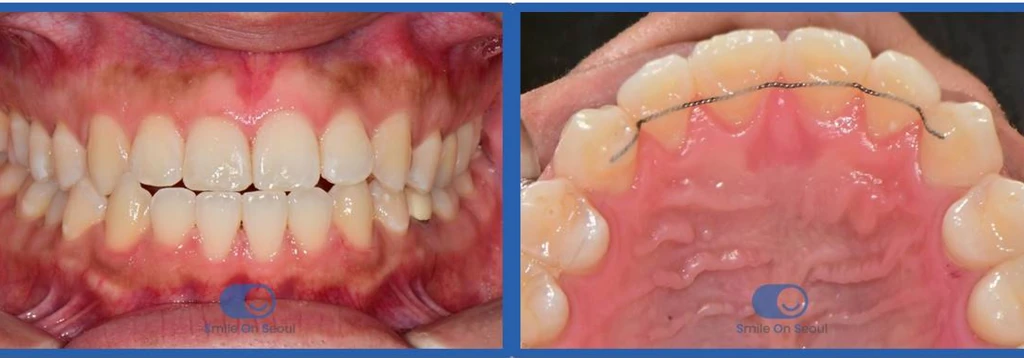 before_image