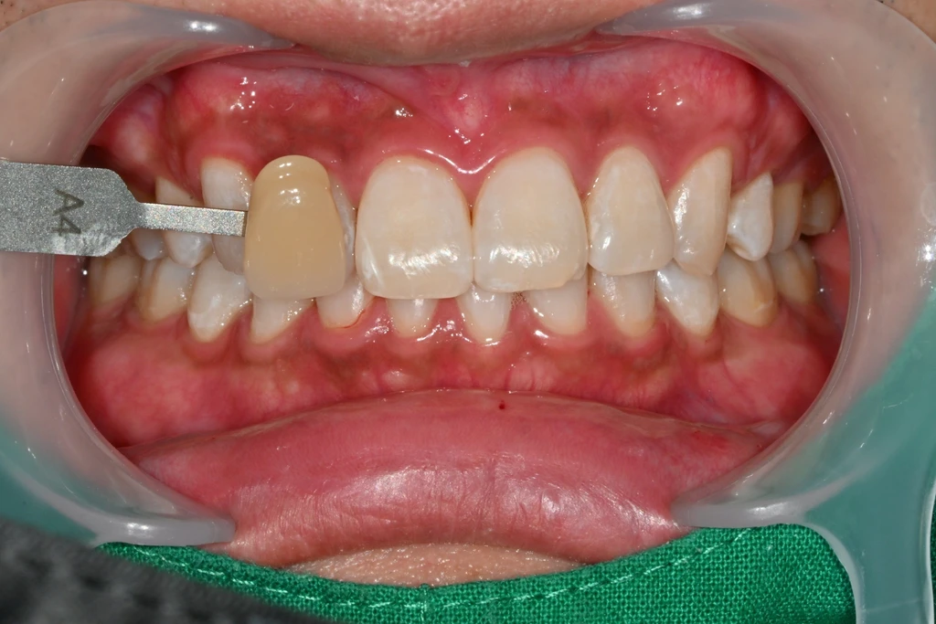before_image
