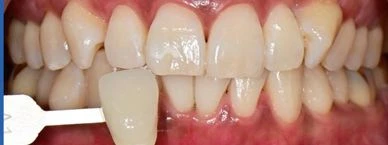 before_image